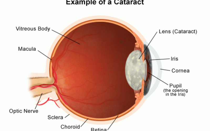 cataracts